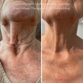 KRX Neck Lift Intensive Firming Neck Cream - Foto 4
